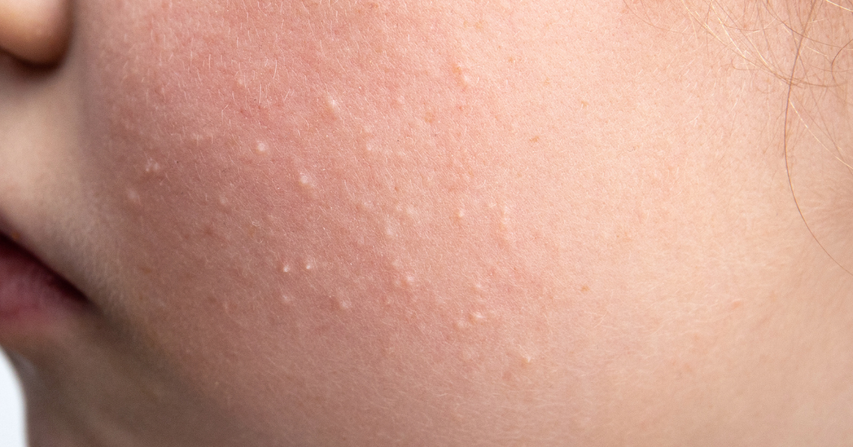 Keratosis Pilaris Treatment in Easton