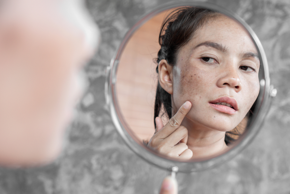 Dark Spot Removal Treatments