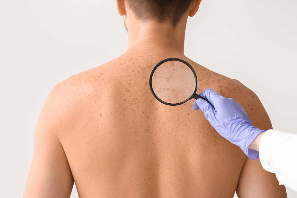 Answers From a Skin Cancer Doctor in Potomac