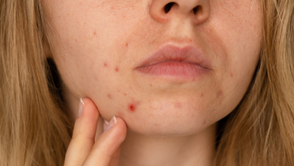Acne Awareness Month