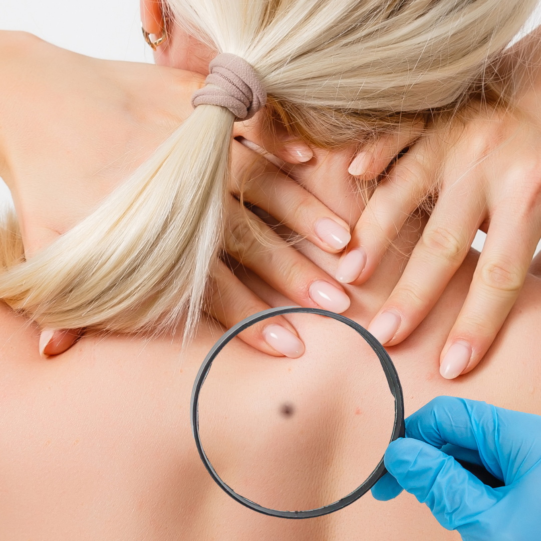 Melanoma Specialist Chevy Chase