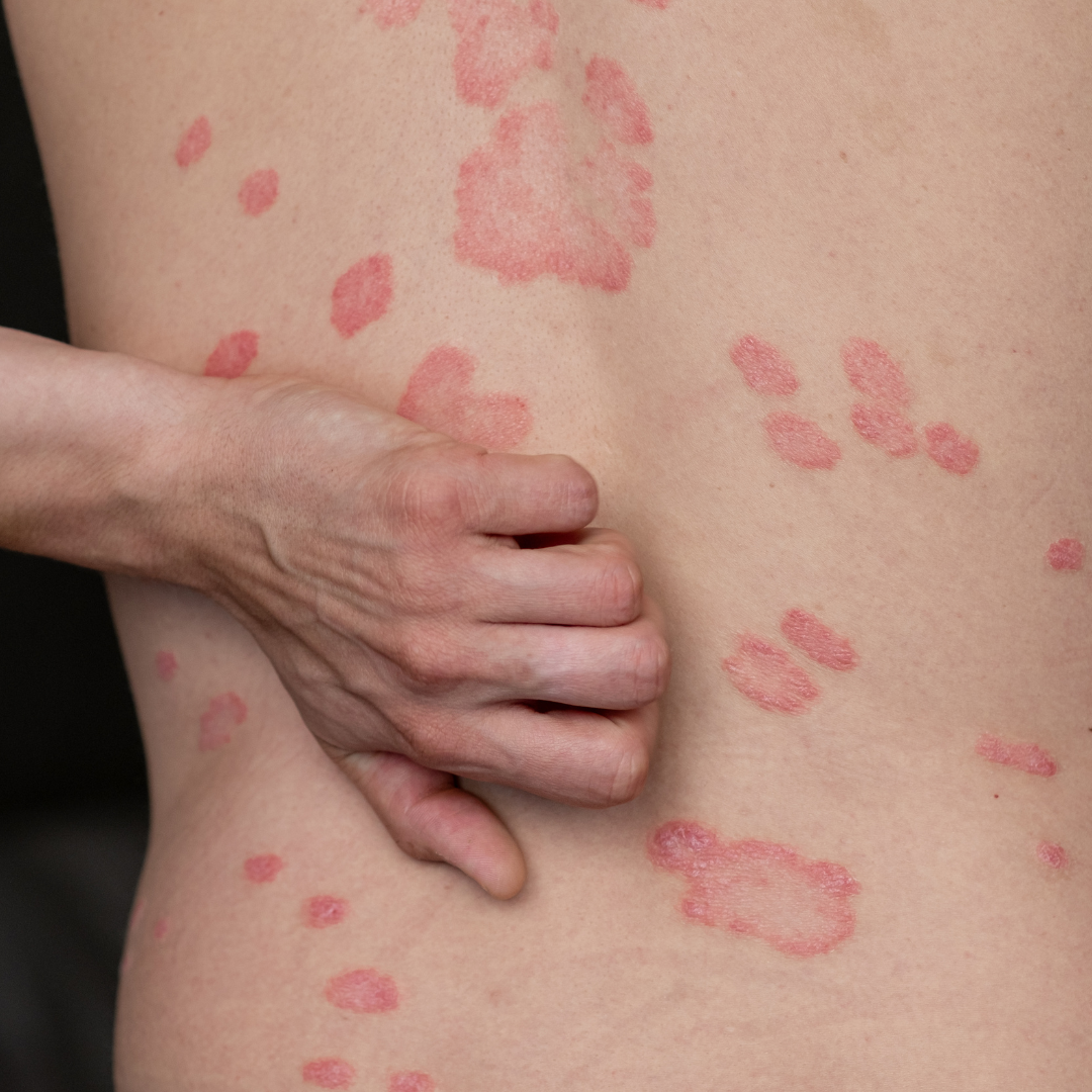 Same-Day Dermatology Appointments Chevy Chase