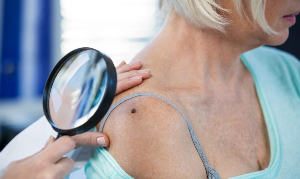 Blue Light Treatments Annapolis – Top Skin Cancer Prevention