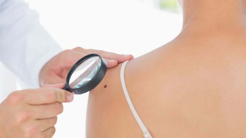 Melanoma specialists near St. Michaels