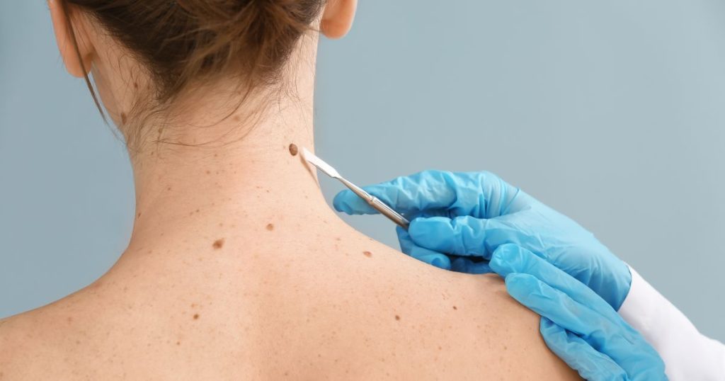 Top Mohs Surgeon Chevy Chase