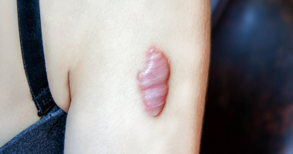 Keloid Scar Removal Chevy Chase