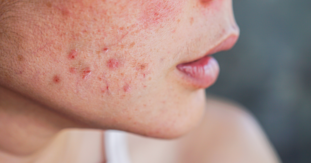 is my acne hormonal