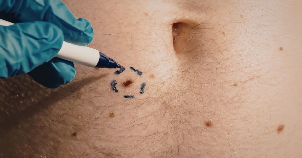 skin biopsy dermatologist in Maryland
